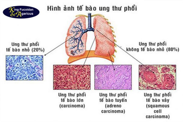 9 dấu hiệu của ung thư phổi bạn không nên bỏ qua