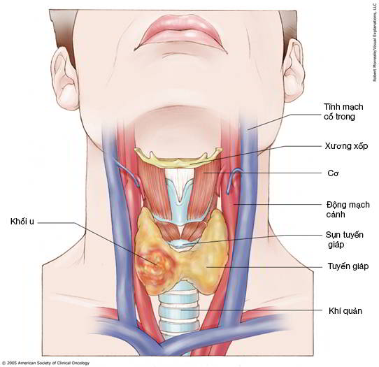 Ung thư vòm họng giai đoạn II